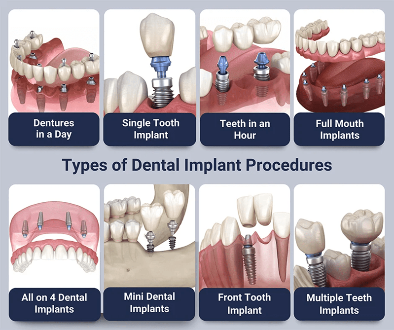 types of dental implants