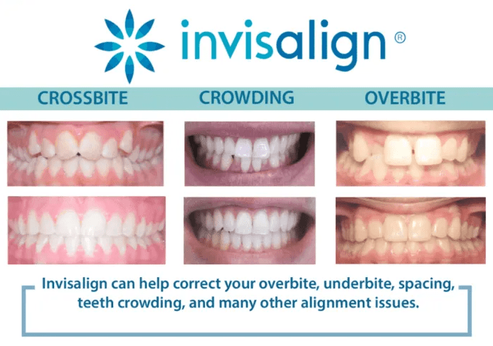 invisalign can help these issues